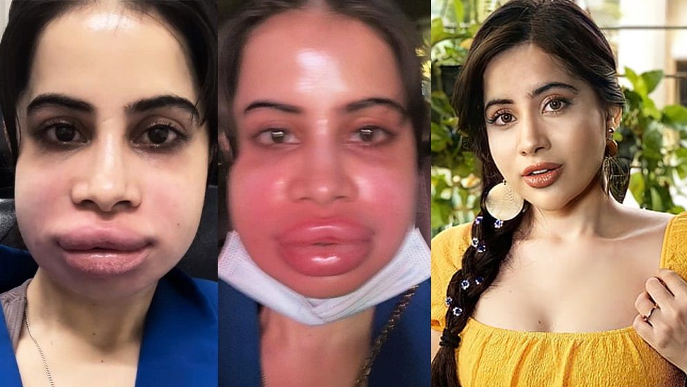 মুখ-ঠোঁট ফুলে ভাইরাল উরফি জাভেদ