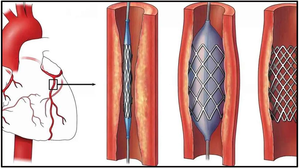 হার্টের রিংয়ের নতুন দাম কার্যকর ১ অক্টোবর থেকে