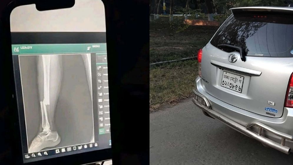 অধ্যাপকের গাড়ির ধাক্কায় পা ভাঙল রাবি ছাত্রীর