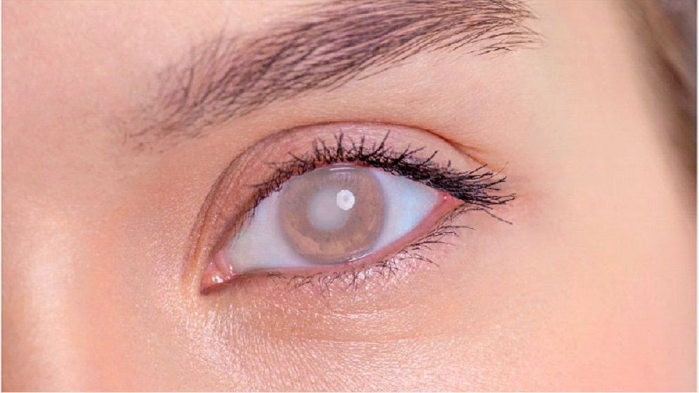 ছানি রোগে আক্রান্ত ৯ কোটি মানুষ, দ্রুত পদক্ষেপ নিতে আহ্বান ডব্লিউএইচওর