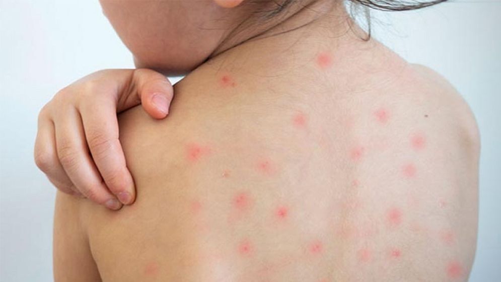 একদিনে হামে ৪ শিশুর মৃত্যু, আক্রান্ত আরও ৬৮৫