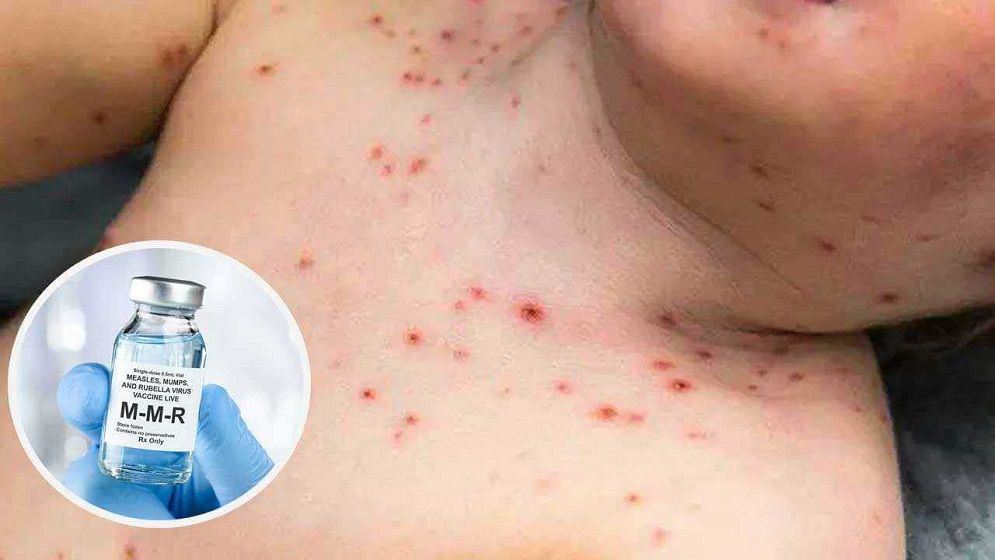 রোববার থেকে জরুরি হামের টিকাদান কর্মসূচি শুরু