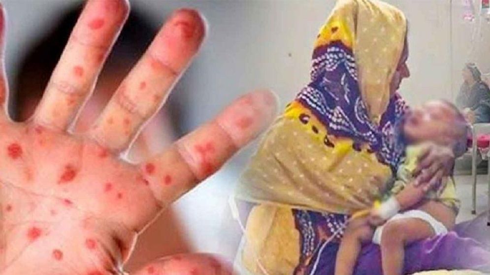 দেশজুড়ে হামে আক্রান্তর সংখ্যা বাড়ছে, ২৪ ঘণ্টায় আরও ১১ জনের মৃত্যু