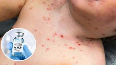 রোববার থেকে জরুরি হামের টিকাদান কর্মসূচি শুরু