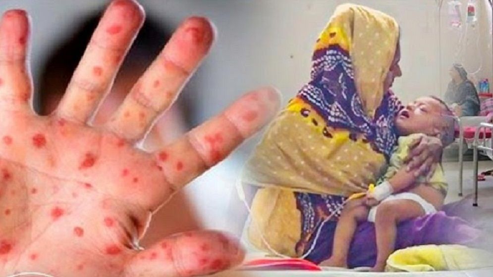 ২৪ ঘণ্টায় হাম ও উপসর্গে আরও ৬ শিশুর মৃত্যু