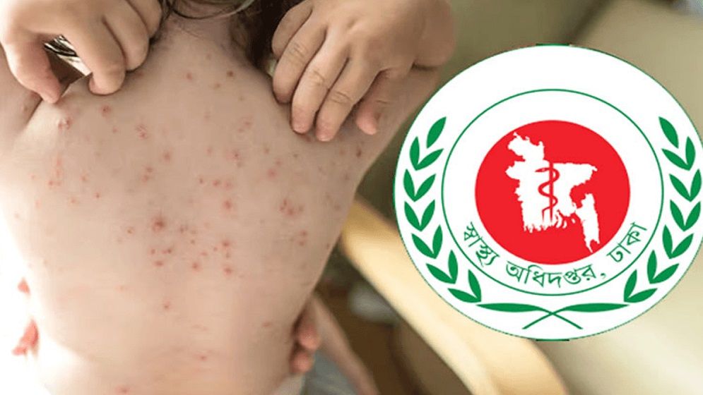 ২৪ ঘণ্টায় হাম উপসর্গে আরও ৫ শিশুর মৃত্যু