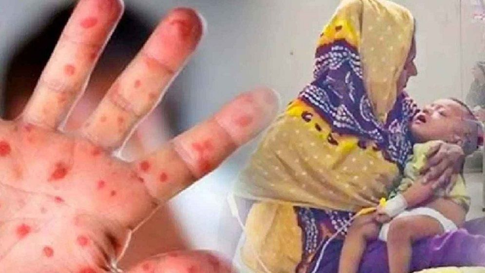 দেশে হামে আরও ৩ জনের মৃত্যু, মোট প্রাণহানি ৯২৮