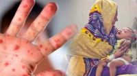 দেশে হামে আরও ৩ জনের মৃত্যু, মোট প্রাণহানি ৯২৮