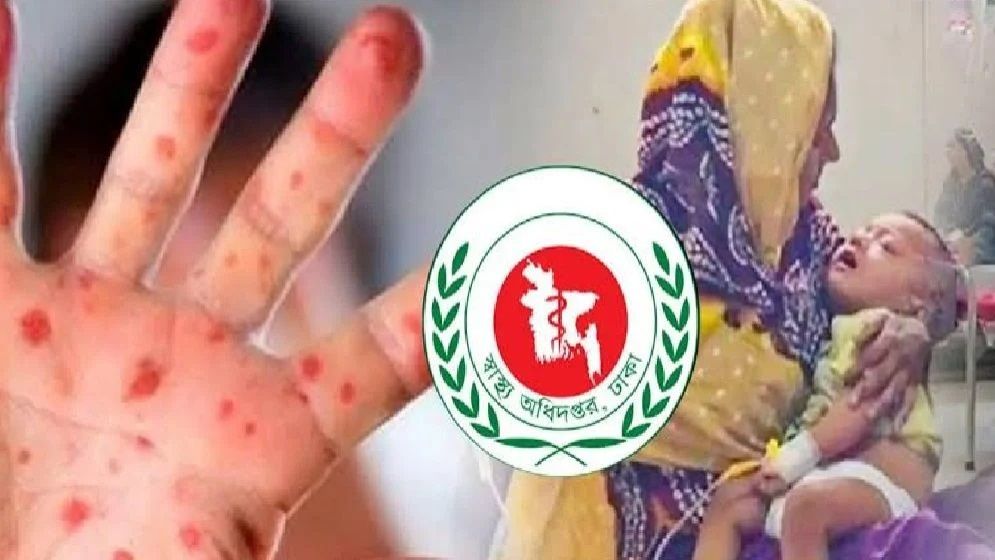 হাম ও উপসর্গ নিয়ে ২৪ ঘণ্টায় ৩ শিশুর মৃত্যু