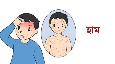হাম উপসর্গে গত ২৪ ঘণ্টায় আরও ২ শিশুর মৃত্যু