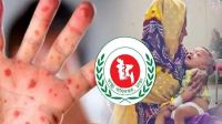 হাম ও উপসর্গ নিয়ে ২৪ ঘণ্টায় ৩ শিশুর মৃত্যু