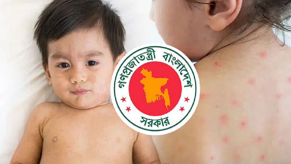 হাম উপসর্গে আরও ৭ শিশুর মৃত্যু, ২৪ ঘণ্টায় আক্রান্ত ১২৭৩