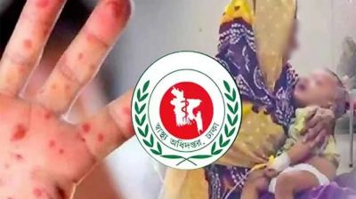 হাম উপসর্গে আরও ৭ শিশুর মৃত্যু